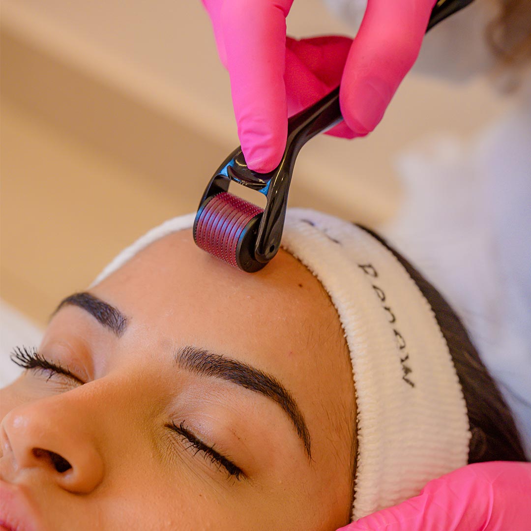 Microagulhamento facial em progresso